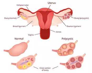 <b>警惕子宫肌瘤：了解其潜在危害</b>